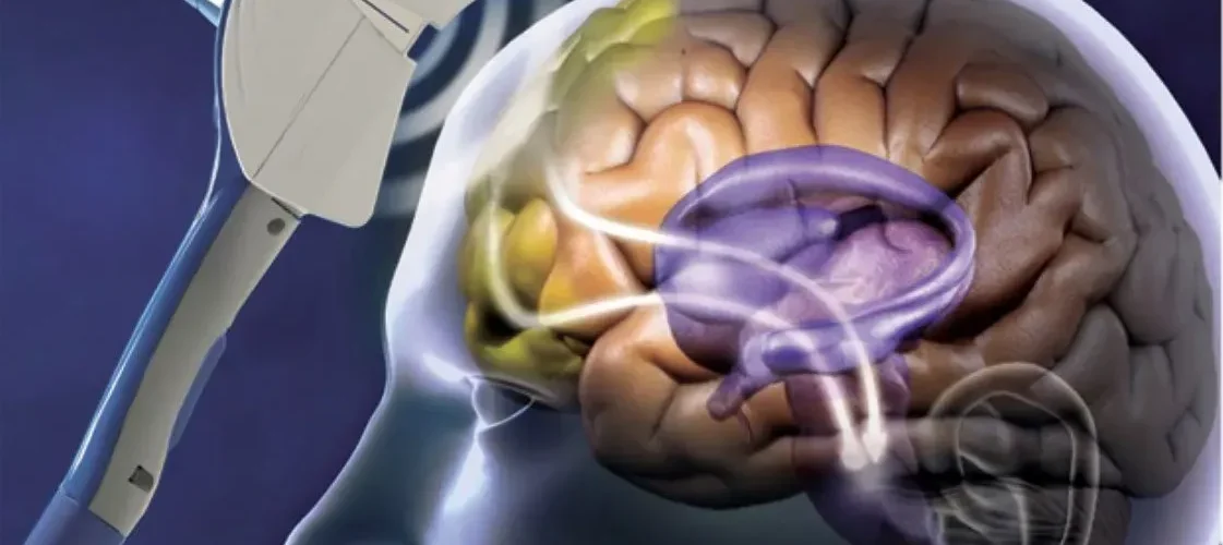 Transcranial Magnetic Stimulation