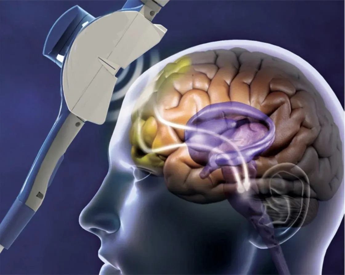 Transcranial Magnetic Stimulation
